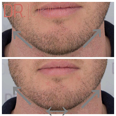 Jawline Fillers Melbourne | Dr. Jodie